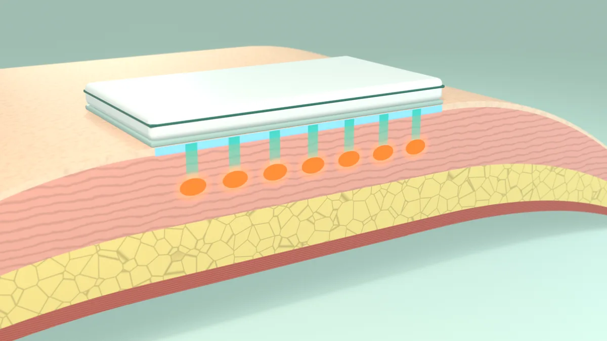 A curved slab of skin layers cut open at the front, with a flat cooling plate on top: seven parallel beams run straight down to a row of heated zones in the middle of the dermis, above the fat and a thin muscle layer.