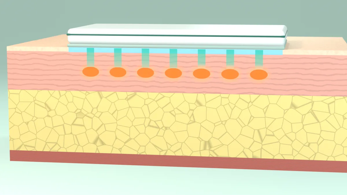 A side-on cut-away of neck skin under a flat cooling plate: seven parallel beams reach a row of heated zones in the middle of the dermis, and the thick fat layer and thin muscle sheet below carry no heat.